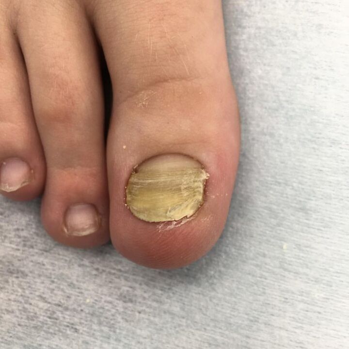 Infection with fungus