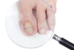 Causes of nail fungus