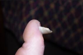 Symptoms of fungal on nails