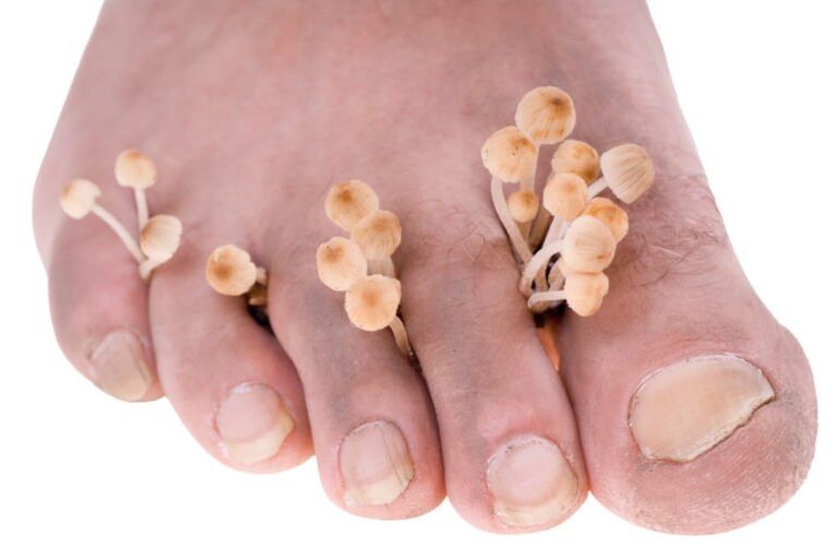 fungus on foot symptoms