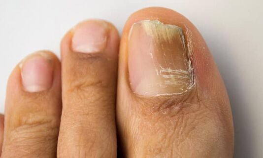 Distal-lateral damage with onychomycosis in the legs