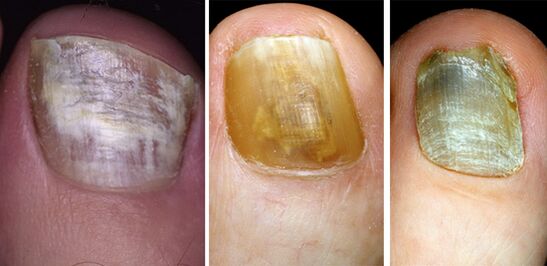 In the photo, change the color of the nails in the feet with a fungal disease