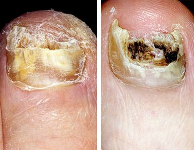 The amount of nail destruction in the foot