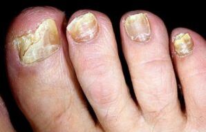 Symptoms of toenail fungus