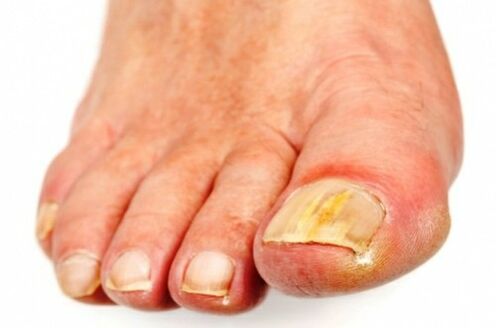 The first fungus affects the nails of the first and fifth toes